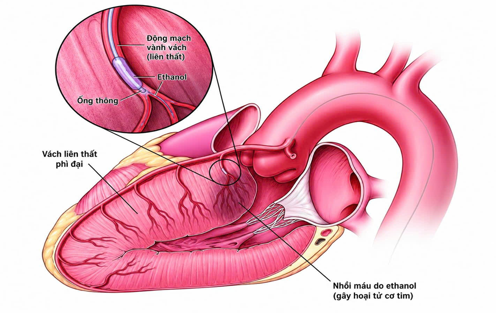 Minh họa cơ chế của kỹ thuật triệt đốt vách liên thất bằng cồn tuyệt đối trong điều trị bệnh cơ tim phì đại tắc nghẽn